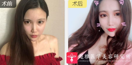 自体脂肪填充术