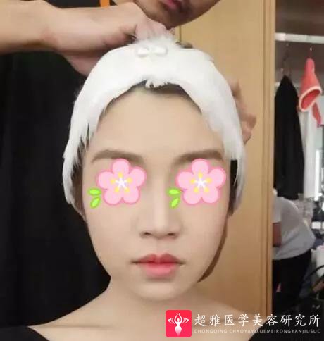自体脂肪填充术