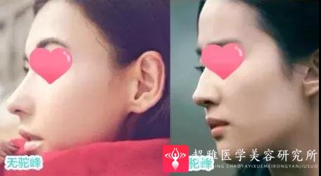 隆鼻手术