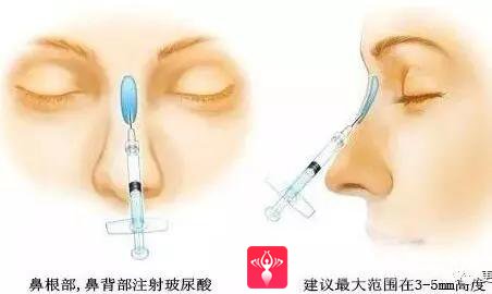 隆鼻手术