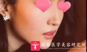 隆鼻手术
