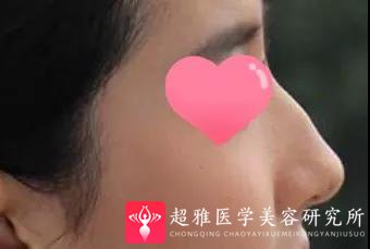 隆鼻手术