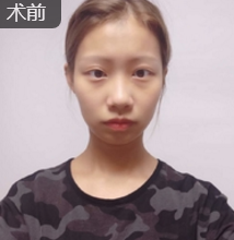 自体脂肪填充术