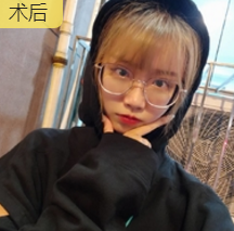自体脂肪填充术