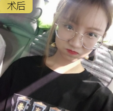 自体脂肪填充术