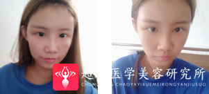 自体脂肪填充术
