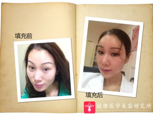自体脂肪填充术