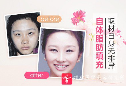 自体脂肪填充术