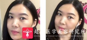 面部提升术
