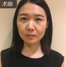 面部提升术