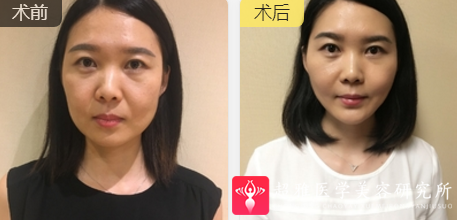 面部提升术