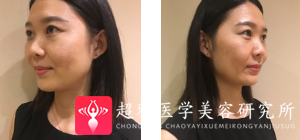 面部提升术
