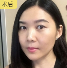面部提升术