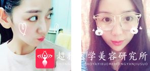面部提升术