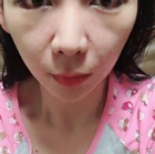 面部提升术