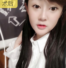 隆鼻手术