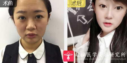 隆鼻手术