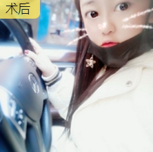 隆鼻手术