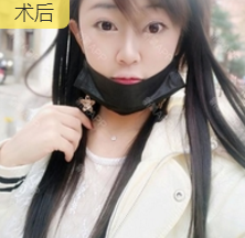 隆鼻手术