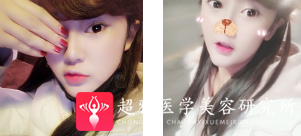隆鼻手术
