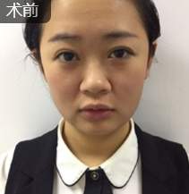 隆鼻手术
