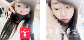 隆鼻手术