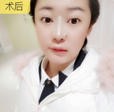 隆鼻手术