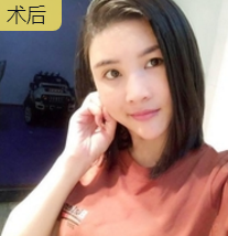 自体脂肪填充术