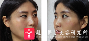 自体脂肪填充术