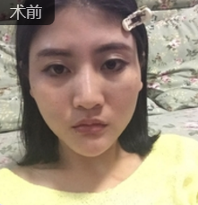 自体脂肪填充术