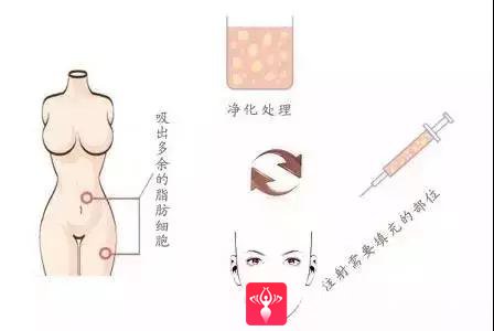 自体脂肪填充术
