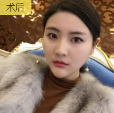 自体脂肪填充术