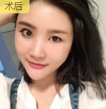 自体脂肪填充术
