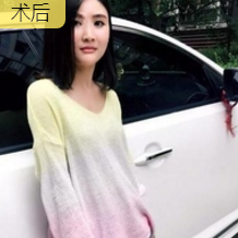 自体脂肪填充术