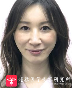 面部提升术