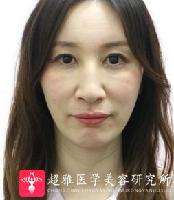 面部提升术