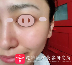 面部提升术