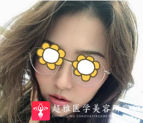 面部提升术