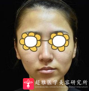 面部提升术
