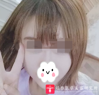 面部提升术