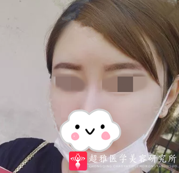 面部提升术