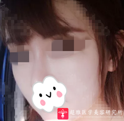面部提升术