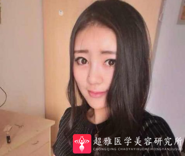 不开刀隆鼻