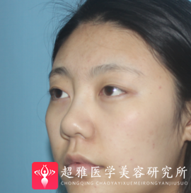 不开刀隆鼻