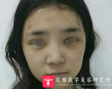 超声波瘦脸