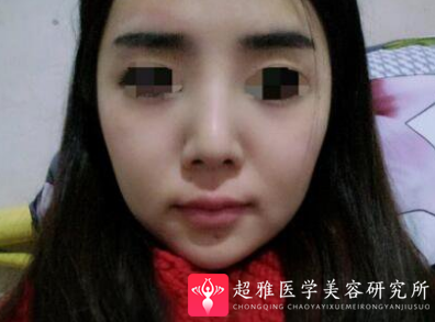 超声波瘦脸