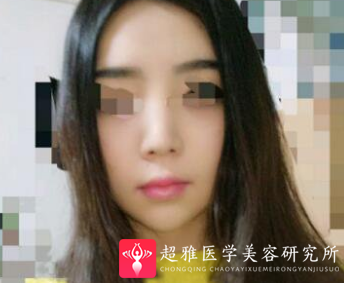 超声波瘦脸