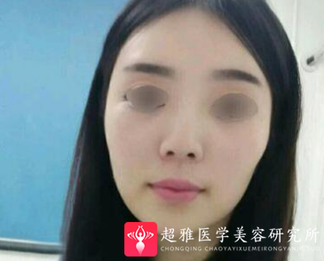 超声波瘦脸