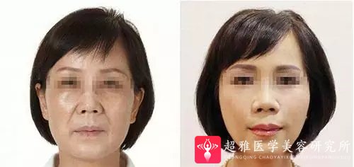 面部提升术