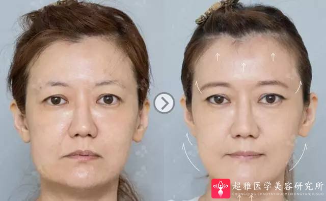 面部提升术